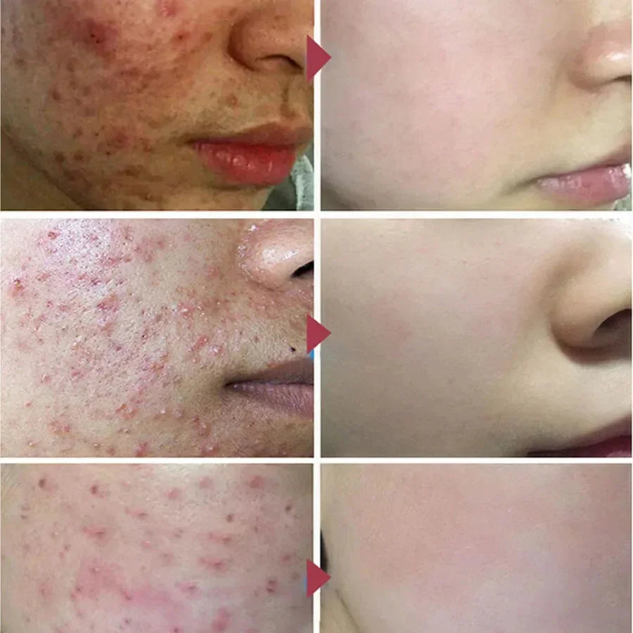 Pimple Scar Removal Herbal Gel – Anti-Acne & Skin Lightening