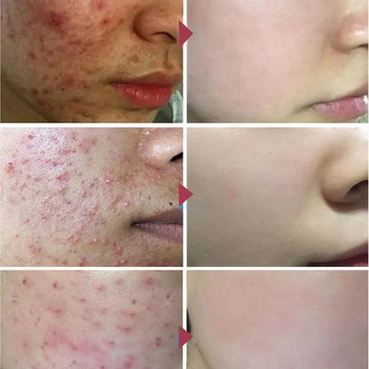 Pimple Scar Removal Herbal Gel – Anti-Acne & Skin Lightening